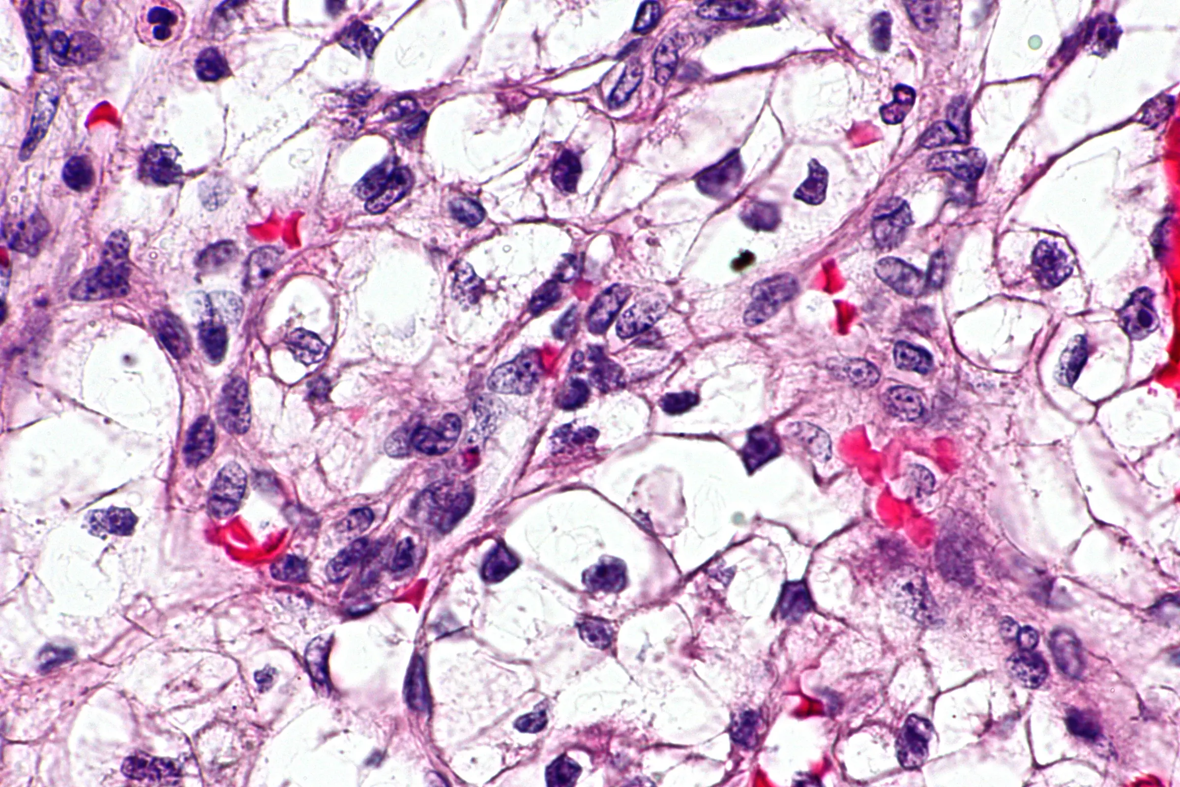 Cancer cells under a microscope, stained pink and purple